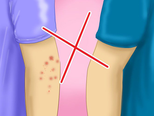 Neem contact op met schurft