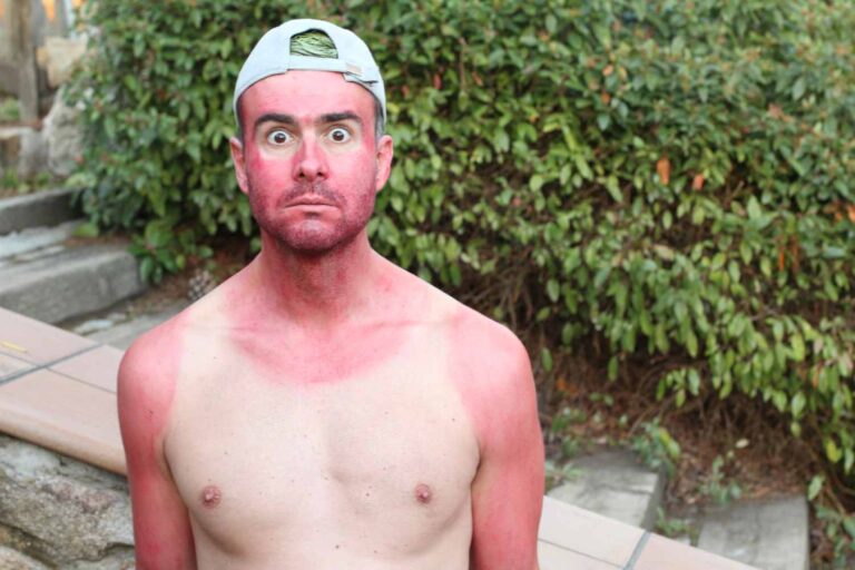 Extreme Tan: Jongeren verbranden hun huid voor een virale uitdaging op Tiktok (en dermatologen lanceren het alarm)
