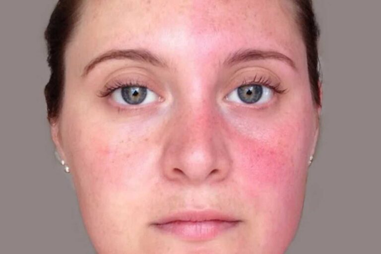 sindrome di arlecchino