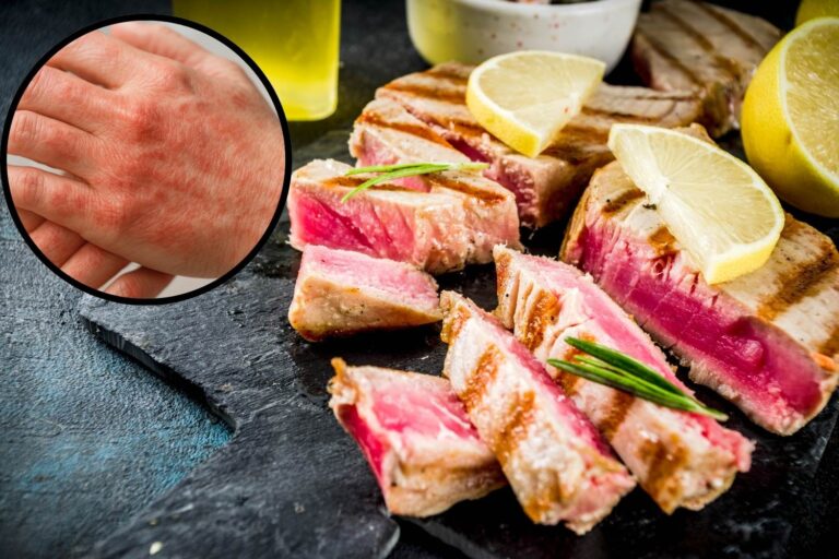 tonno sindrome sgombroide