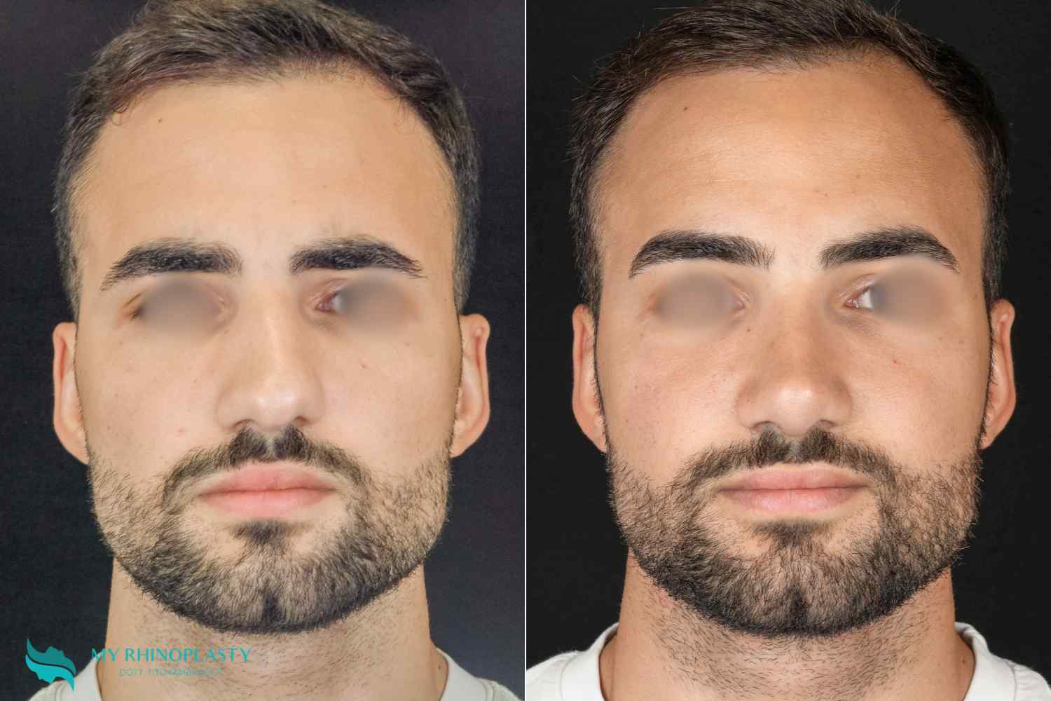 afwijkend neustussenschot 