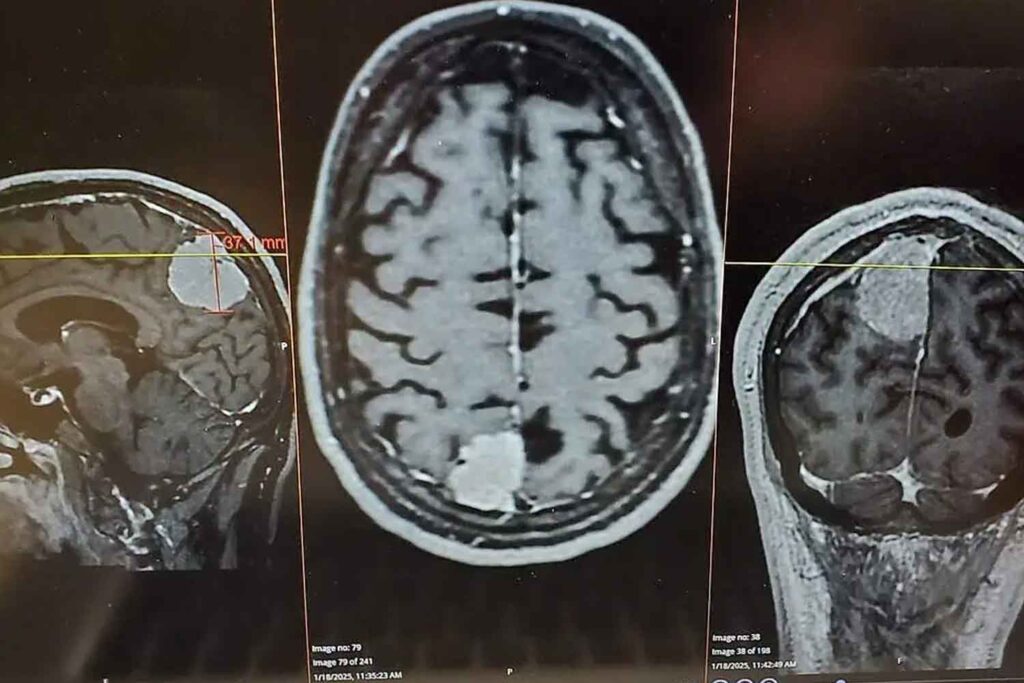 scansione cancro al cervello