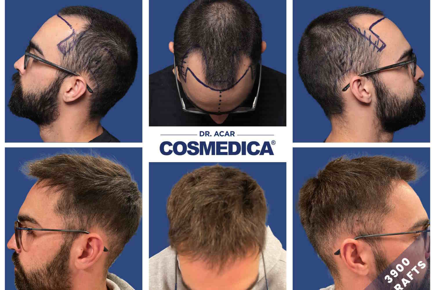 haartransplantatie Turkiye