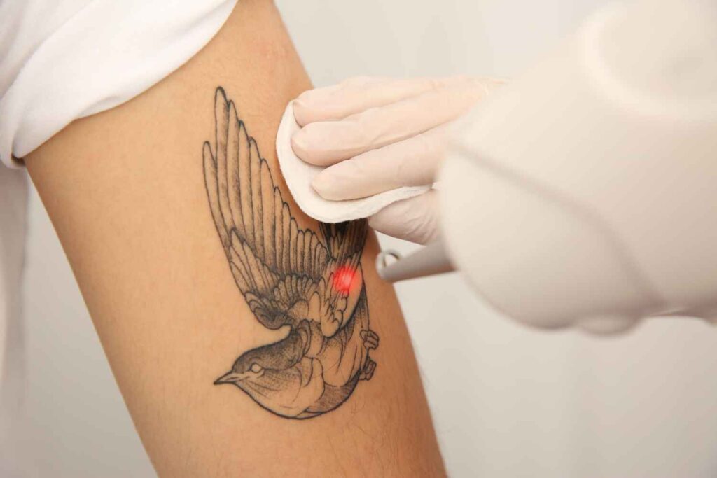 cancellare tatuaggio